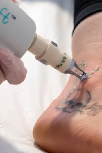 Tattoo-removal (1)