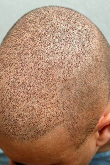 hair-transplant (1)